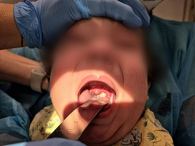 Téměř vymýcená nemoc je zpět. Kojenec dostal dvě dávky séra proti záškrtu