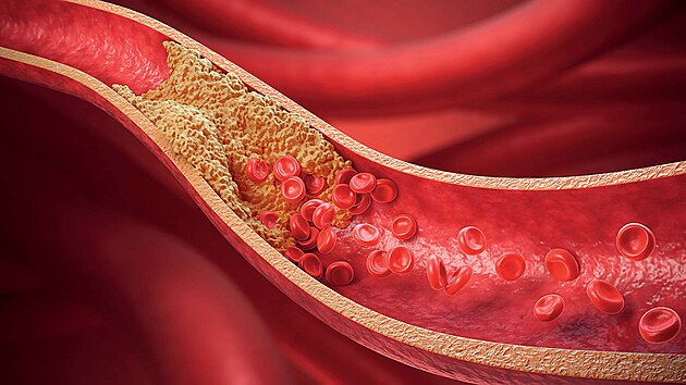 Cholesterol je p�irozenou sou��st� krve. Je d�le�it� pro zpracov�n� tuk� v...