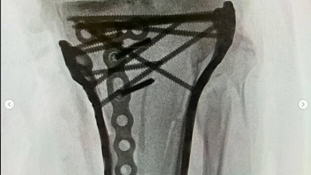 Rentgenov� sn�mek zlomen� nohy Lindsey Vonnov� po p�du v olympijsk�m sjezdu v Cortin�. Americk� ly�a�ka m� za sebou u� p�tou operaci, posledn� z�krok ve Spojen�ch st�tech trval p�es �est hodin.