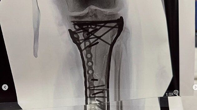 Rentgenov� sn�mek zlomen� nohy Lindsey Vonnov� po p�du v olympijsk�m sjezdu v Cortin�. Americk� ly�a�ka m� za sebou u� p�tou operaci, posledn� z�krok ve Spojen�ch st�tech trval p�es �est hodin.