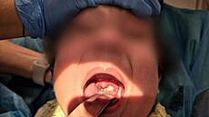 Jedno z d�tí hospitalizovaných ve Fakultní nemocnici Ostrava s kr�ní formou...