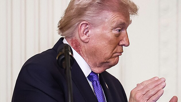 Americk� prezident Donald Trump se na slavnostn�m p�ed�v�n� Medail� cti ve V�chodn�m s�le B�l�ho domu ve Washingtonu objevil s �erven�m flekem na krku. (2. b�ezna 2026)