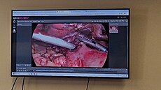 Brn�nská SurGal Clinic provádí zákroky, které potla�ují obezitu.