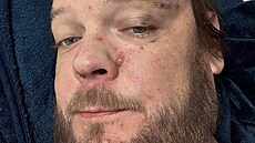 Corey Harrison zve�ejnil snímky z mexické nemocnice po nehod� na motorce