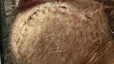 T�iapadesátiletá Dana z ji�ních �ech bojuje se záke�ným nádorem na mozku....