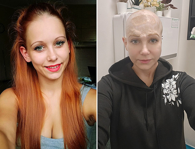 Ženu skalpoval stroj v práci, v nemocnici bojovala o život