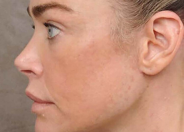 Denise Richardsová podstoupila náročný zákrok, vizuálně omládla o desítky let