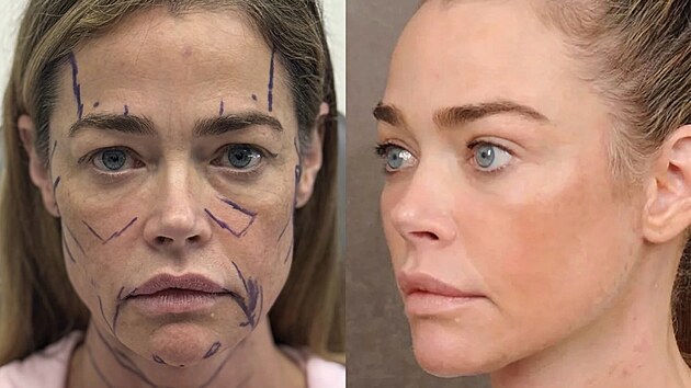 Denise Richardsov� p�ed osmi m�s�ci podstoupila kompletn� facelift obli�eje. Nyn� uk�zala here�ka fotky p�ed z�krokem a po n�m. (b�ezen 2026)