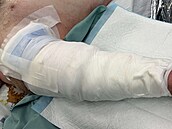 Pacientovi utrhl dopravníkový pás ruku v úrovni pa�e. Brn�nským chirurg�m...