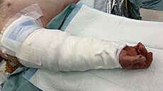 Pacientovi utrhl dopravníkový pás ruku v úrovni pa�e. Brn�nským chirurg�m...