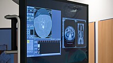 Léka�i z interven�ní radiologie Masarykova onkologického ústavu provedli...