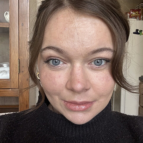 Jennifer Broyden z americké Virginie má extrémní alergii na slunce. Sta�í jí...