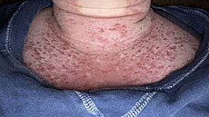 Jennifer Broyden z americké Virginie má extrémní alergii na slunce. Sta�í jí...