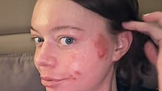 Jennifer Broyden z americké Virginie má extrémní alergii na slunce. Sta�í jí...