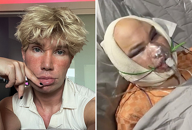 Hvězda Big Brotheru ukázala drastické následky plastiky. Fanoušci byli v šoku Hvězda Big Brotheru ukázala drastické následky plastiky. Fanoušci byli v šoku