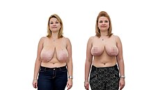 �tená�ka Vít�zslava podstoupila zmen�ení a následnou modelaci obou prs�.