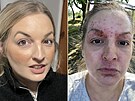 Kv�li reakci na krém m�la �ena na obli�eji boláky.