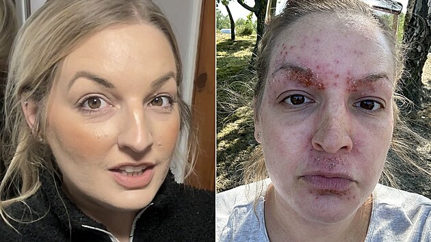 Kv�li reakci na kr�m m�la �ena na obli�eji bol�ky.