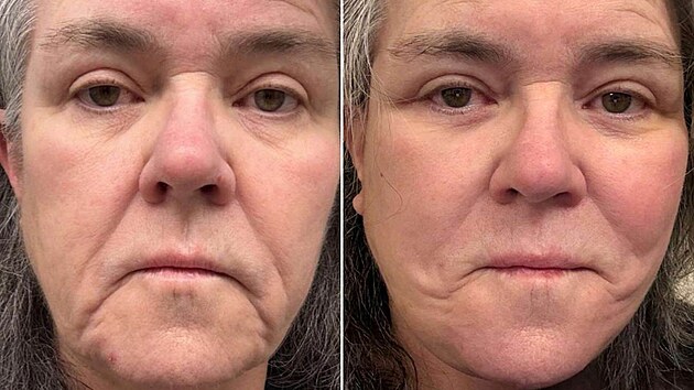 Rosie O�Donnellová p�ed a po faceliftu (2026)