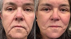 Rosie O�Donnellová p�ed a po faceliftu (2026)