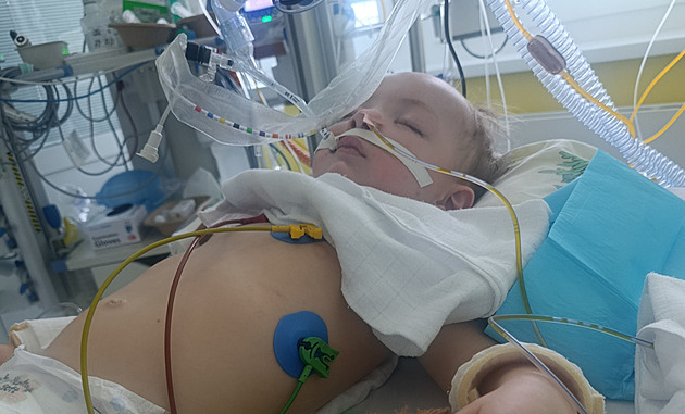 Dvouletý chlapec vdechl kus hrušky, je v kómatu. N