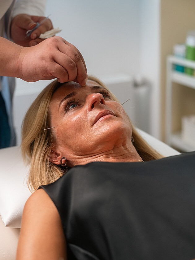 Akupunktura na migr�ny i nespavost: Kde m� ��nsk� medic�na smysl?