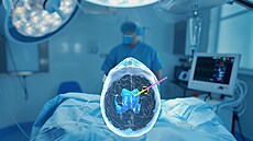 Léka�i neurochirurgického odd�lení bud�jovické nemocnice zavedli v �ervnu do...