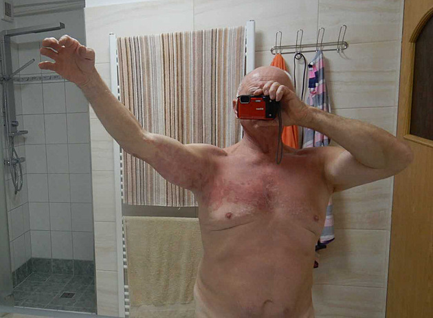 Trpíme krutými bolestmi, popisují pacienti. Pásových oparů rekordně přibylo