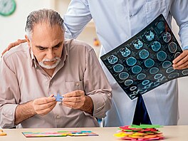 Alzheimerova choroba se projevuje odumíráním nervových bun�k v n�kterých...