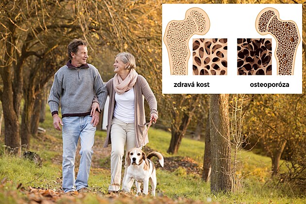 2Osteopor�za