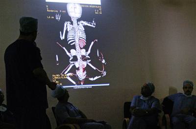 Indití chirurgové debatují nad rentgenovými snímky dívky Lakshmi, narozené s osmi konetinami.
