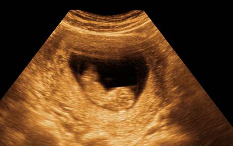 Snímek z ultrazvuku - ilustraní foto.