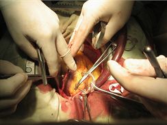 Operace, lékařský zákrok - ilustrační foto