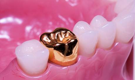 Zlatý zub - ilustraní foto
