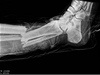 Zlomená noha Wasilewskiho na rentgenovém snímku.