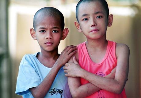 Naděje na zastavení epidemie AIDS? Každým rokem přibude na světě zhruba 5 milionů lidí s virem HIV. Vakcína by mohla šíření nemoci zastavit. Na snímku thajští chlapci, kteří trpí nemocí AIDS již od narození.