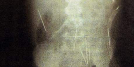 Dvouletý chlapec ml v tle 50 jehel - rentgenový snímek.
