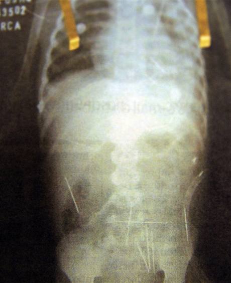 Dvouletý chlapec ml v tle 50 jehel - rentgenový snímek.