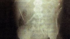 Dvouletý chlapec m�l v t�le 50 jehel - rentgenový snímek.