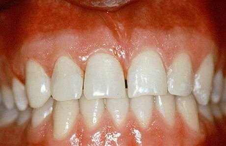 zuby (ilustrační foto)