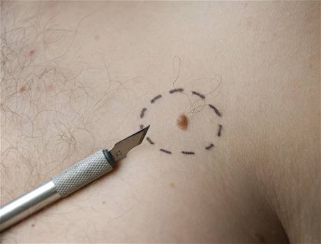 Rakovina kůže - ilustrační foto