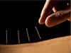 Akupunktura (ilustrační foto)