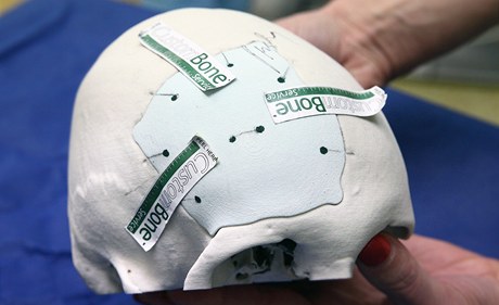 V �. Bud�jovicích pou�ili unikátní náhradu lebe�ní kosti