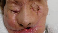 Amerianka, kterou napadl impanz po transplantaci oblieje