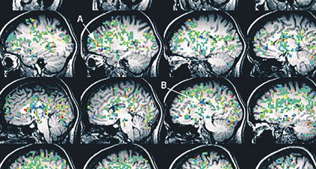 Vyvrcholení. Snímky mozku Kayt Sukelové, zachycené pomocí funkní magnetické rezonance. Barevné ásti znázorují prtok krve, teplejé barvy znamenají vtí prtok.