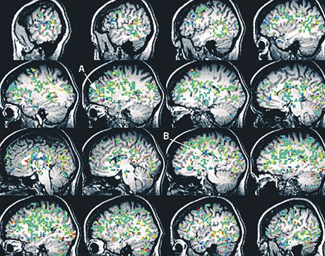 Vyvrcholení. Snímky mozku Kayt Sukelové, zachycené pomocí funkční magnetické rezonance. Barevné části znázorňují průtok krve, teplejšé barvy znamenají větší průtok.