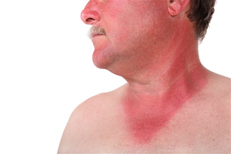 Kůže spálená od sluníčka (ilustrační foto)