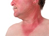 Kůže spálená od sluníčka (ilustrační foto)