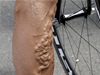 2011 Tour de France: cyklistika bolí, jak dokazuje noha závodníka BMC.