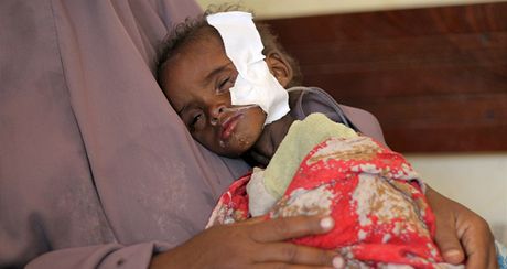 Hlad. V Somálsku dnes nejvíc trpí dti, hlavn podvýivou.